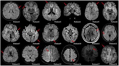 Brain network analysis of interictal epileptiform discharges from ECoG to identify epileptogenic zone in pediatric patients with epilepsy and focal cortical dysplasia type II: A retrospective study